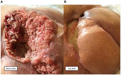 Treatment of metastatic squamous cell carcinoma arising in sacrococcygeal pilonidal sinus: a case report series